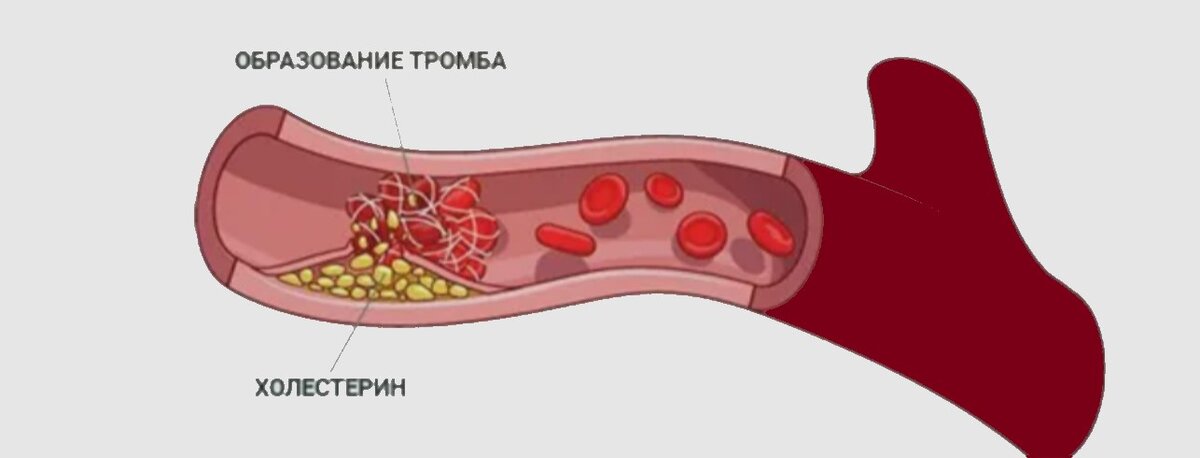 Тромб и Холестериновая бляшка
