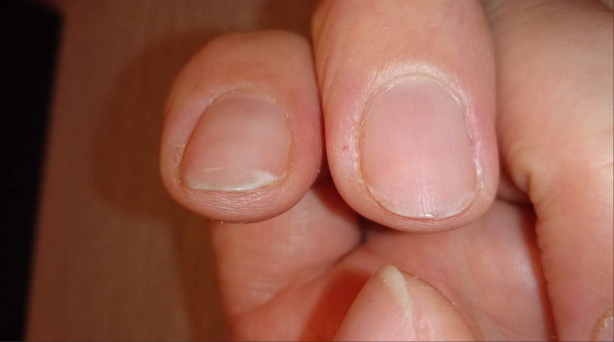 ломкие ногти