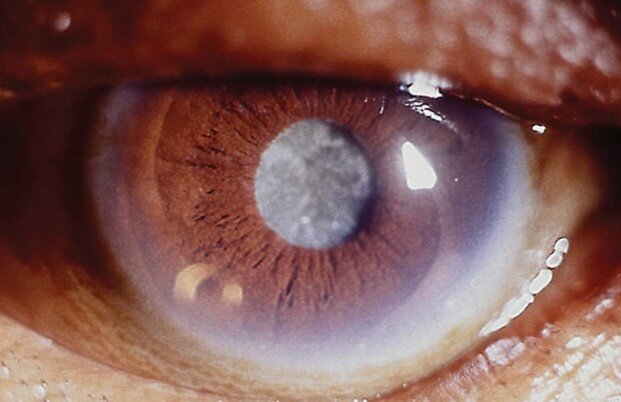 Глаз с катарактой V степени.