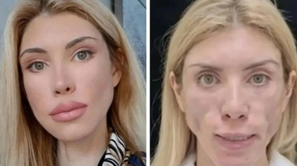 Юлия Тарасевич до и после операции, фото: соцсети