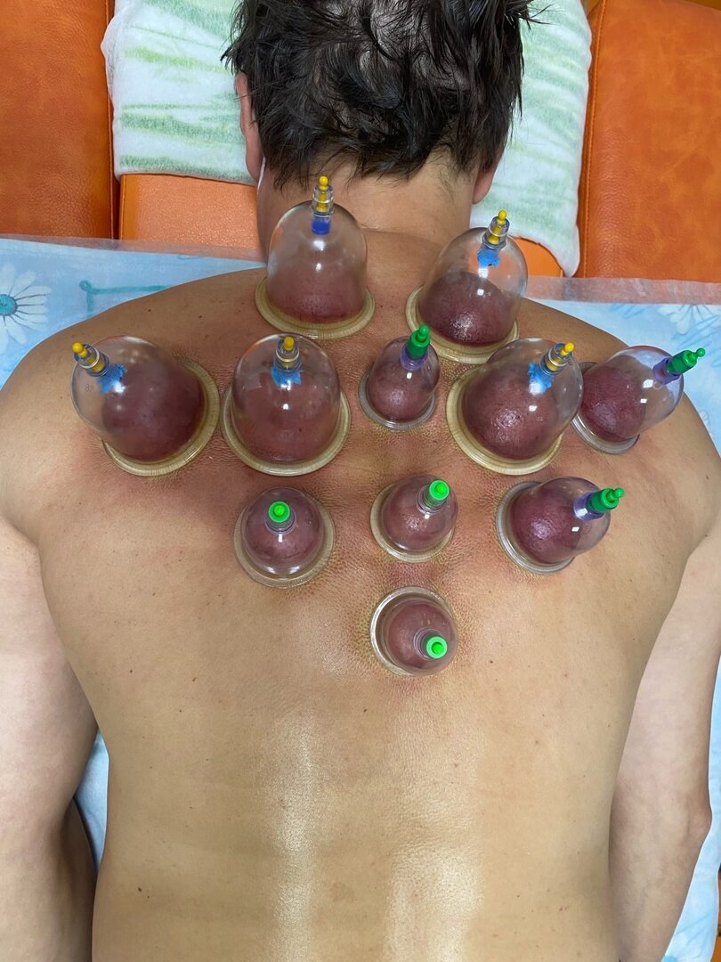 капилляротерапия хиджама. как пользоваться банками для массажа. банки matwave для вакуумного массажа из антиаллергенной резины м-04 (4 шт). вакуумный массаж банками. банки массажные силиконовые для вакуумного массажа.