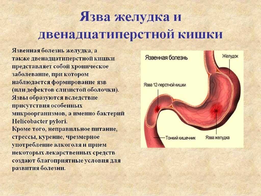 Ябж и 12 перстной кишки. Язвенная болезнь желудка и 12 перстной. Язвенная болезнь желудка и 12 перстной кишки. Язвенная болезнь 12 перстной кишки симптомы. Основные симптомы язвенной болезни желудка и 12-перстной кишки.