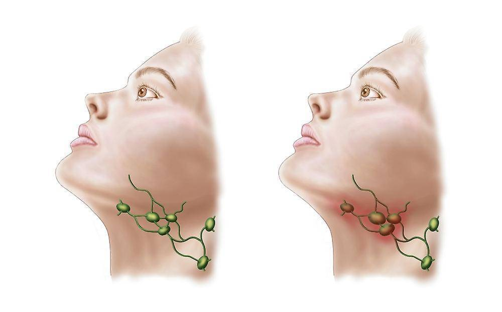 Почему воспаляется лимфатический узел. Воспаление лимфоузлов - лимфаденит. Гнойный шейный лимфаденит. Тонзиллярные лимфоузлы. 4. Шейный лимфаденит.