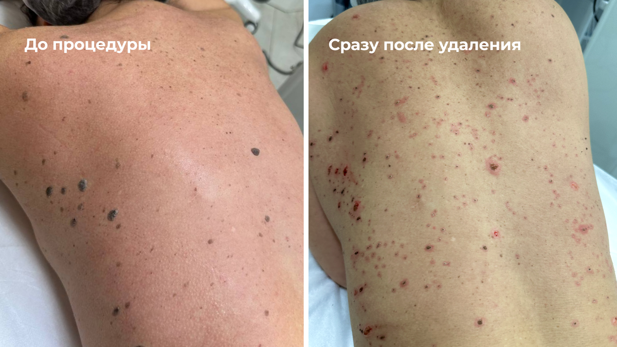 Лазерное удаление кератом на спине: до сразу после процедуры