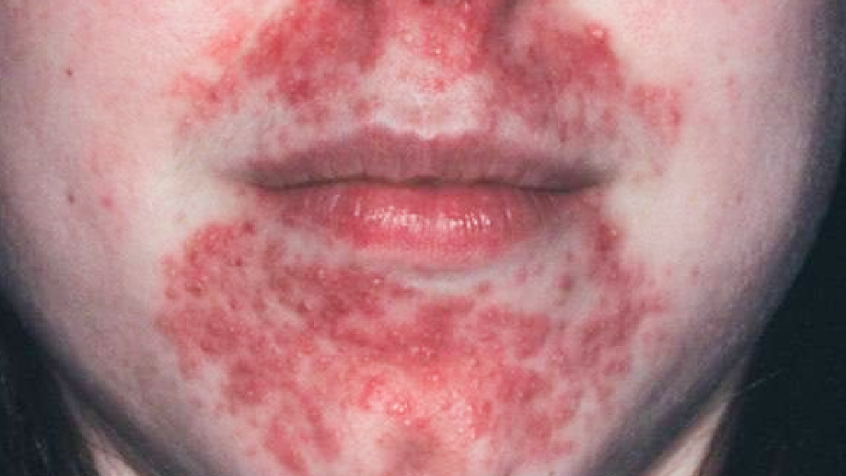 Проявления периорального дерматита