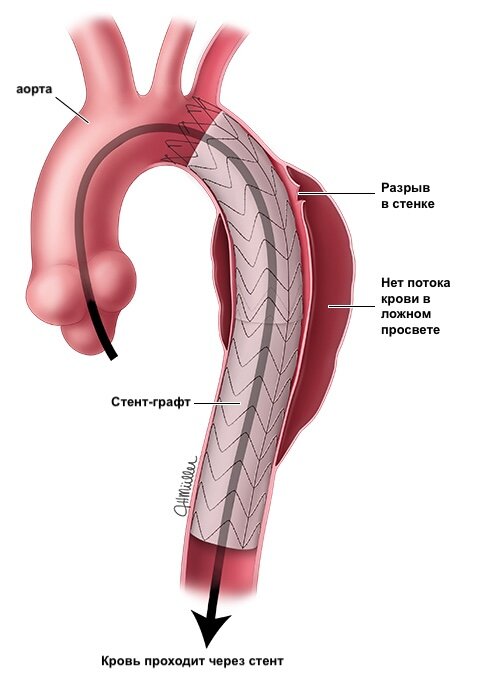 Припев на разрыв аорты. Типы эндоликов стент-графт. Thoracic Aorta.