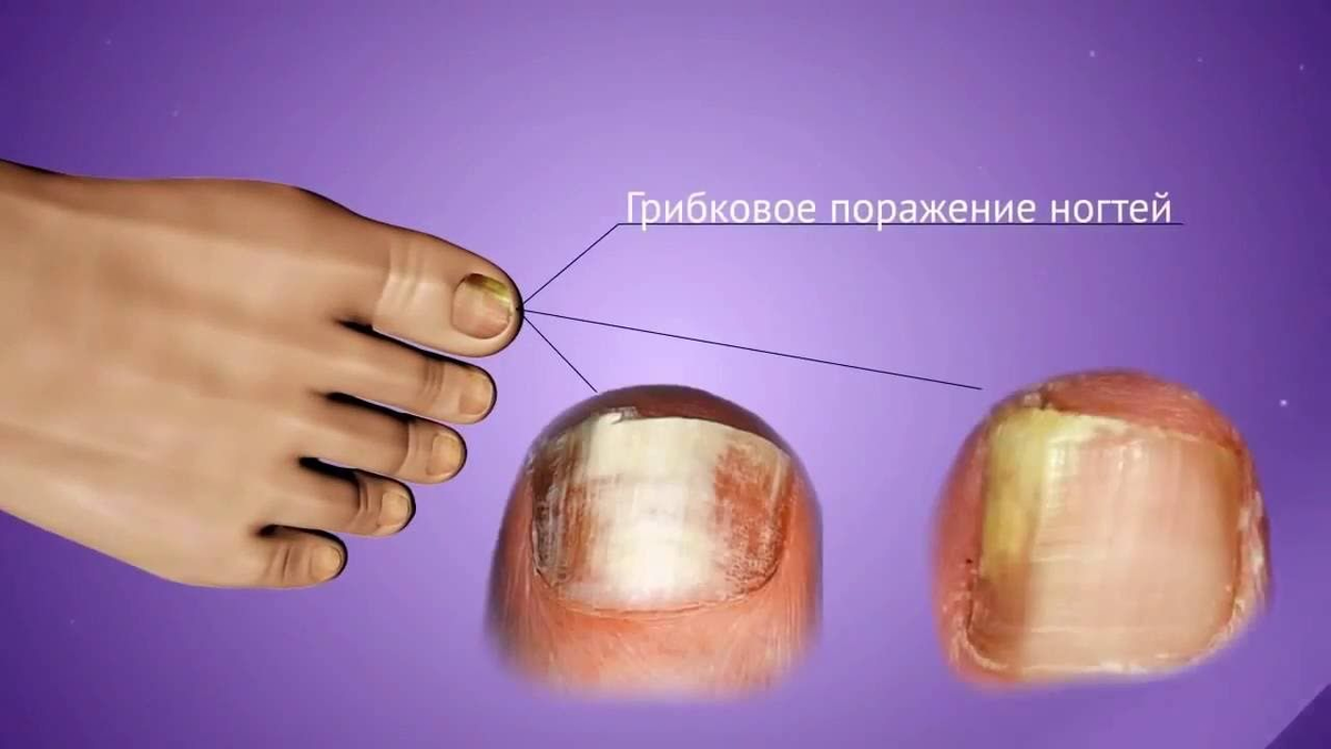 Ногти изменили цвет, крошатся и утолщаются – возможно, это грибок! Но не  всегда и не у всех | О здоровье: с медицинского на русский | Дзен