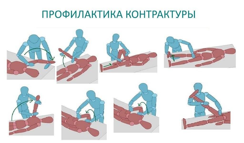 Контрактура реабилитация. Профилактика контрактур после инсульта. Контрактуры суставов конечностей. Профилактика мышечных контрактур. Методы профилактики контрактур у больных.