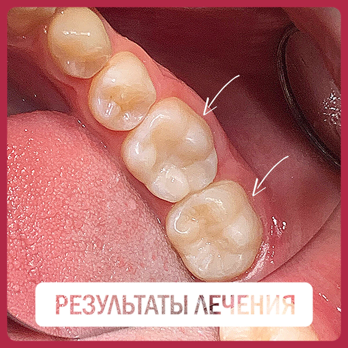 Лечение глубоко кариеса (гиперемия пульпы) 36, 37 зубов у юноши 13-ти лет. Стоимость лечение за два зуба составила 12300 р., время работы 1,5 часа. Работа врача стоматолога-терапевта, зам.гл.