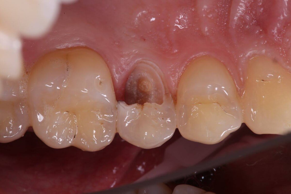 Во время осмотра пациента, был обнаружен скол на зубе 15. Врач-стоматолог принял решение спасать зуб и восстановить его с помощью установки коронки