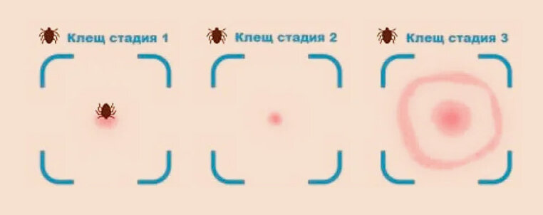 Что делать при укусе клеща: алгоритм действий.