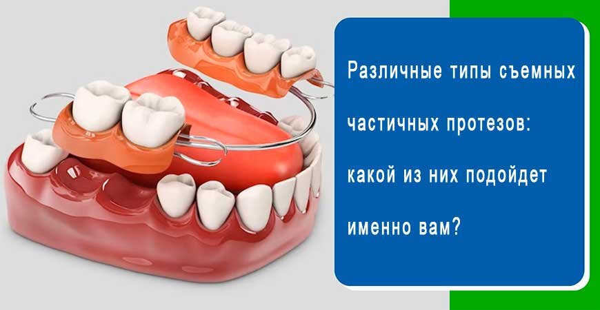 Различные типы частичных съемных зубных протезов.