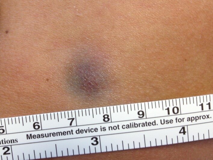 Опухоль Беднара, локализующаяся коже левого плеча. Первоисточник - Almeida FT, Carvalho SD, Pereira T, Brito C. When a bruise gets important: Bednar tumour. BMJ Case Rep. 2019 Feb 11;12(2):e228446. 
When a bruise gets important: Bednar tumour - PMC (nih.gov)