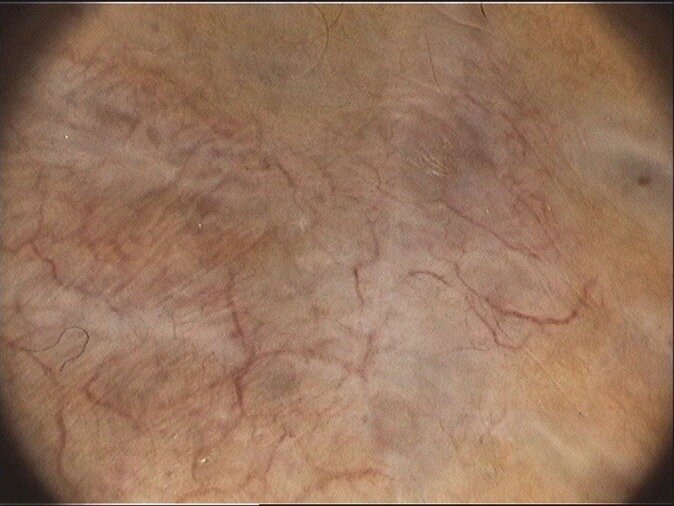 Дерматоскопическая картина. Первоисточник - Almeida FT, Carvalho SD, Pereira T, Brito C. When a bruise gets important: Bednar tumour. BMJ Case Rep. 2019 Feb 11;12(2):e228446. 
When a bruise gets important: Bednar tumour - PMC (nih.gov)