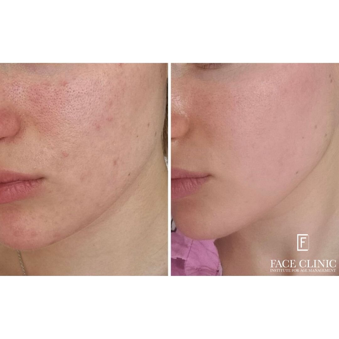 Пример лечения розацеа в Face Clinic. Врач-дерматовенеролог, косметолог, трихолог Гусеинова Эльвира Эльмановна.