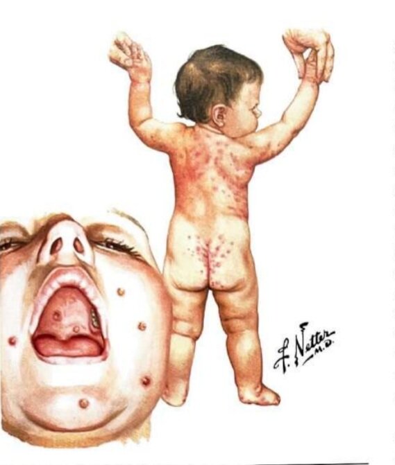 Инфекционные болезни с иллюстрациями Неттера, 2021 