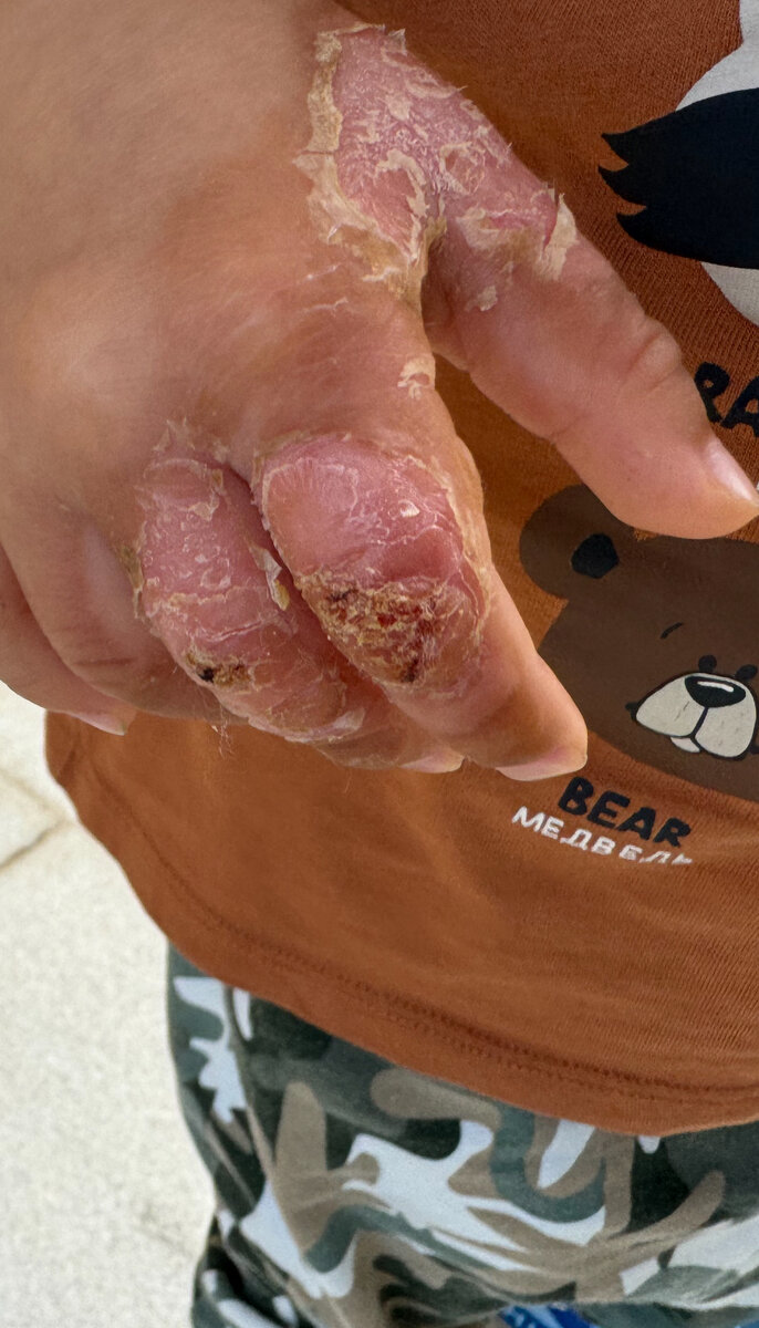 Так рука выглядела через неделю после ожога 