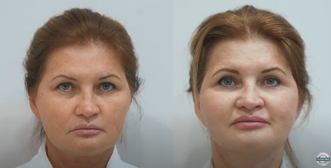 Пациентка Светлана. ДО и ПОСЛЕ операции