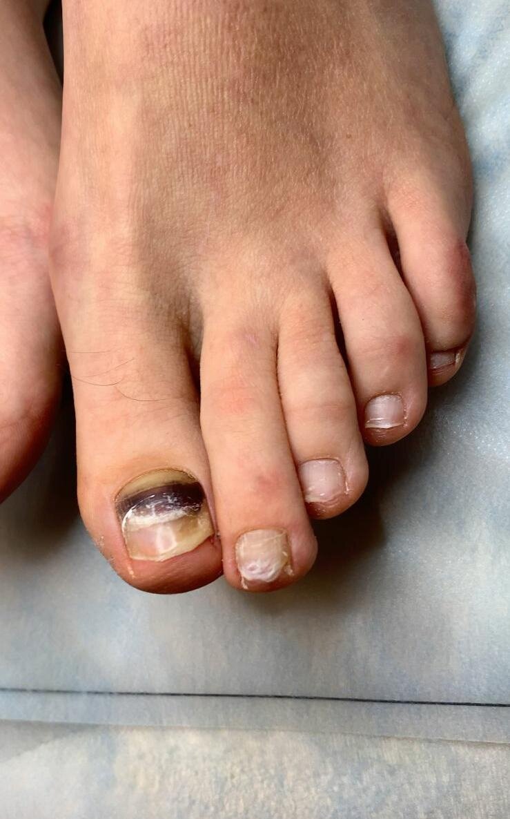 Гематома под ногтем
