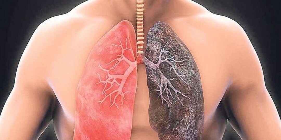 Мифы и правда о хронической обструктивной болезни легких
