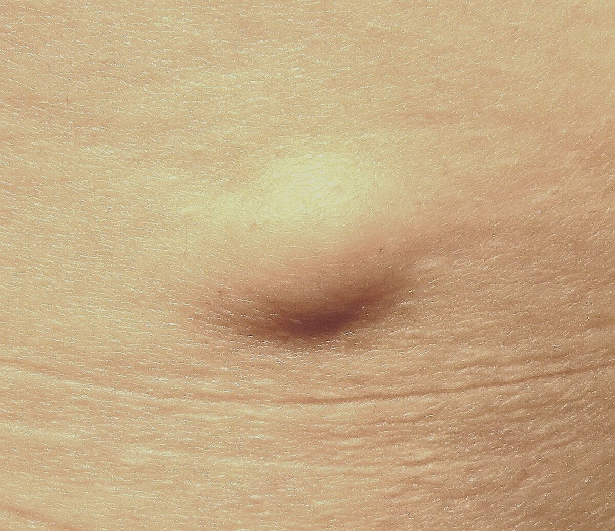 Внешне атерома выглядит вот так.