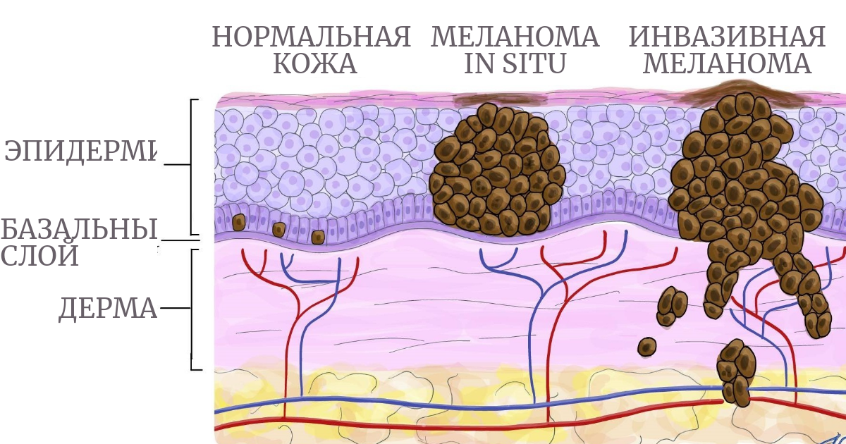 развитие меланомы