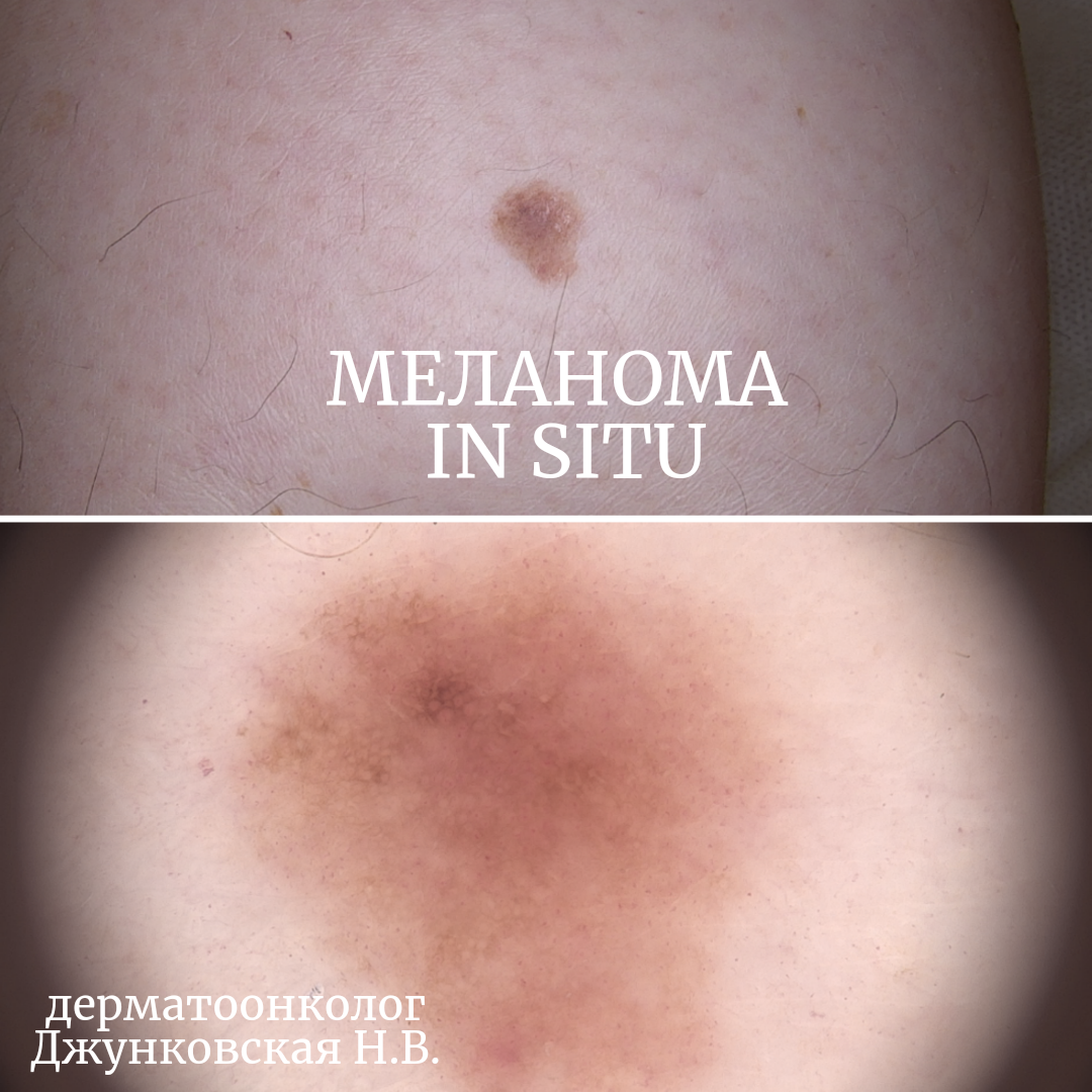 Случай 1, задняя поверхность голени