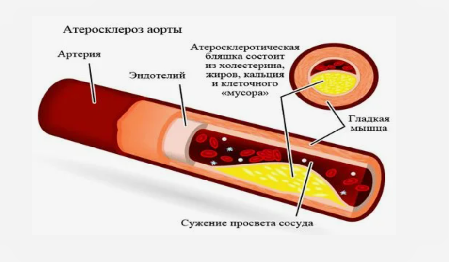 Если у вас высокий холестерин: атеросклероз аорты и его последствия для организма