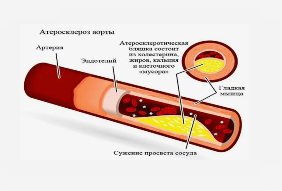 Атеросклероз в области аорты достаточно распространенное состояние. Он может приводить к опасному для жизни состоянию – аневризме аорты, при разрыве которой возможен летальный исход.