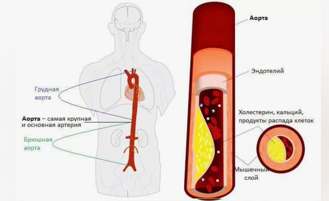 Атеросклероз в области аорты достаточно распространенное состояние. Он может приводить к опасному для жизни состоянию – аневризме аорты, при разрыве которой возможен летальный исход.-2