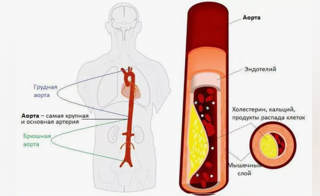 Как лечить аортосклероз. Атеросклероз брюшного отдела аорты снимок. Клинические проявления атеросклероза аорты. Атеросклеротические изменения стенок аорты. Атеросклероз грудного отдела аорты.