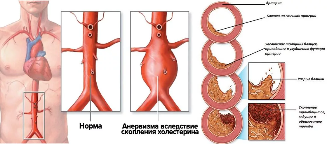 Атеросклероз брюшной аорты - причины, симптомы, кто лечит