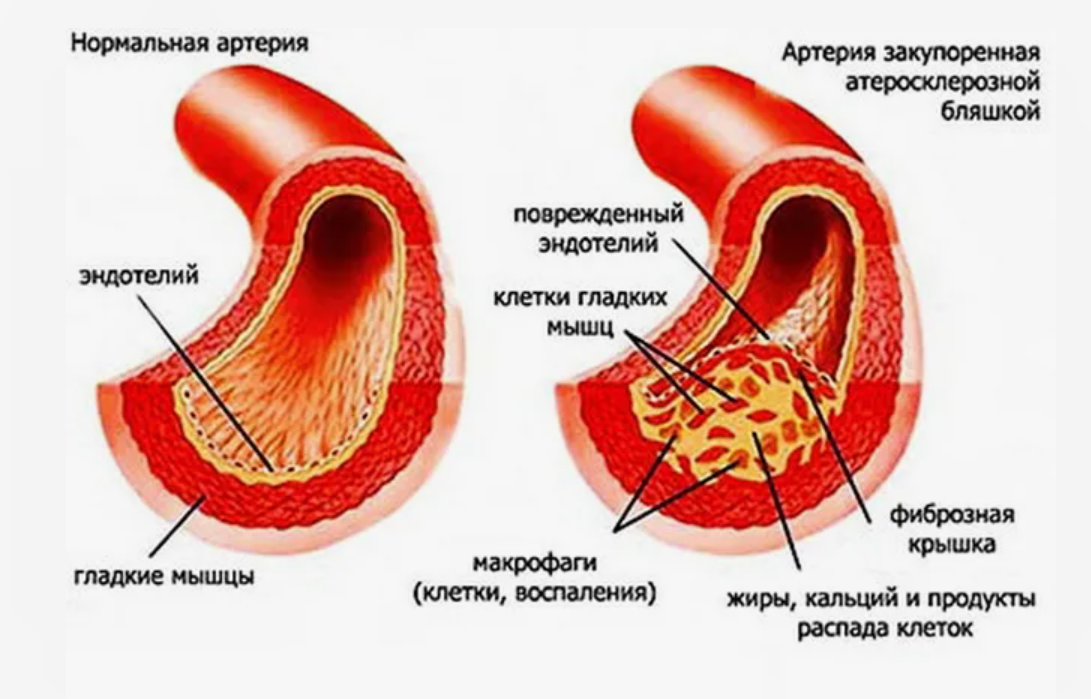 Склероз брюшной аорты. Атеросклероз фиброзные бляшки. Атеросклероз аорты и сосудов. Атеросклеротические изменения стенок аорты. Атеросклероз венечных артерий.