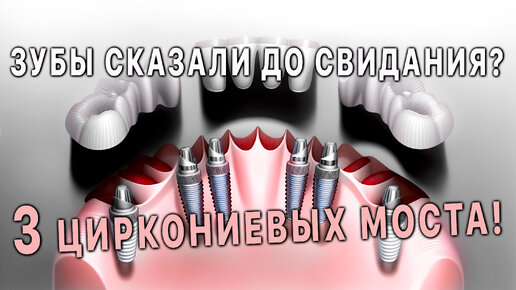 Протезирование без десны на 3 циркониевых мостах.