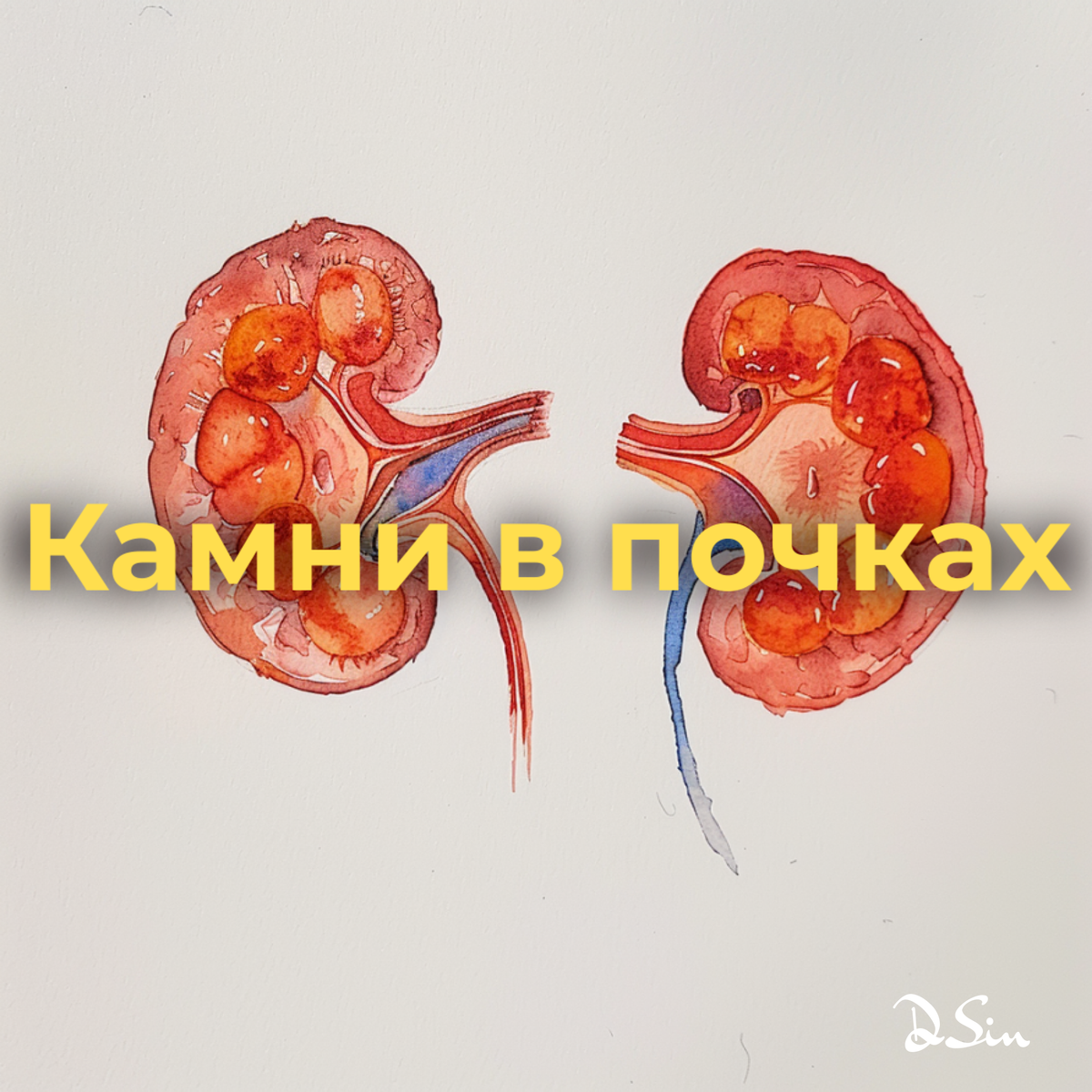 Мочекаменная болезнь