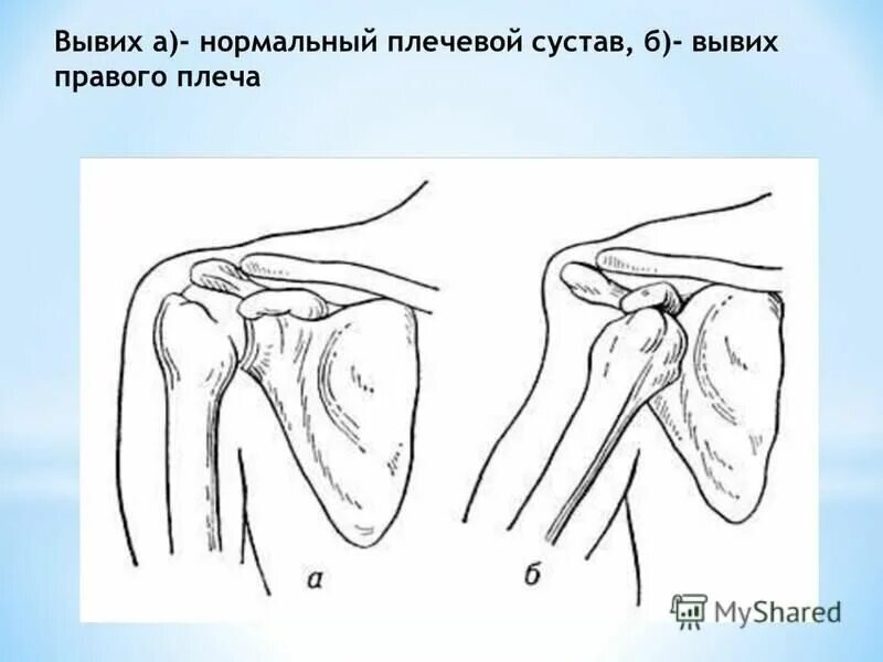 Вывихнуть. Подвывих плечевой кости рентген. Вывих плечевого сустава на рентгенограмме. Подклювовидный вывих плечевого сустава. Вывих плечевой кости рентген.