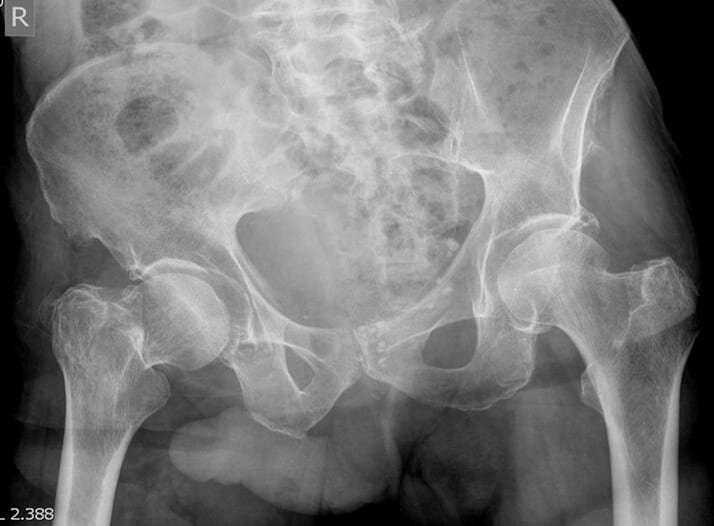 перелом шейки бедра справа и положительный симптом Джона Томаса 