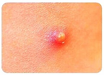 Классический вид фурункула. 