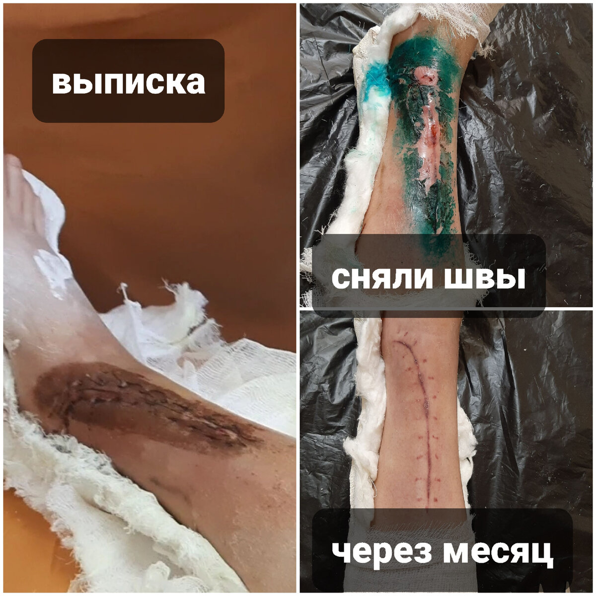 Вот так выглядел мой шов: после выписи, после снятия швов и через месяц