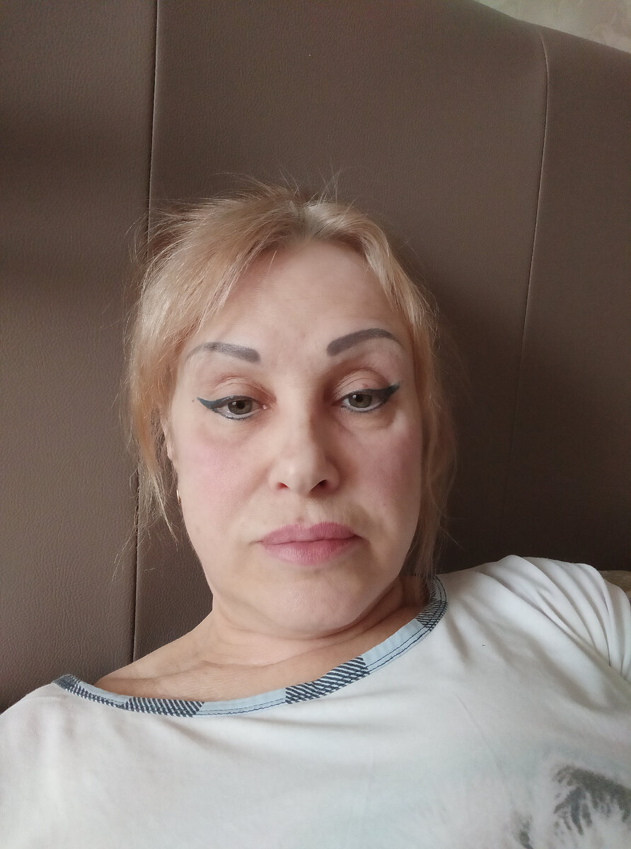 После лекарств и постоянных болей вид не совсем ...но как есть.Розоватость  на щеках от аллергии после лекарств .