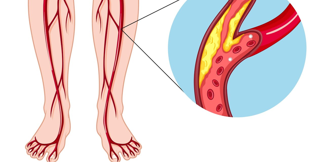 Боль, хромота и риск гангрены: чем опасен атеросклероз сосудов нижних конечностей