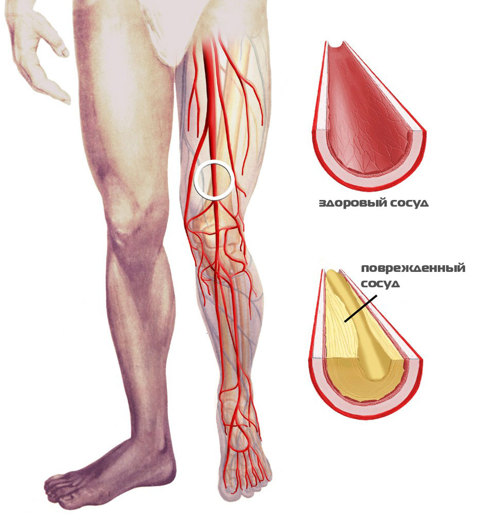 Боль, хромота и риск гангрены: чем опасен атеросклероз сосудов нижних  конечностей | О здоровье: с медицинского на русский | Дзен