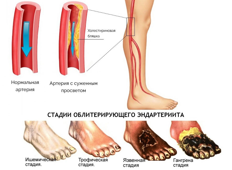 Отнялись ноги у пожилого человека. Болезнь облитерирующий атеросклероз сосудов нижних конечностей. Атеросклероза (облитерирующего) артерий ног. Облитерирующий атеросклероз голени. Атеросклероз сосудов нижних конечностей по стадиям.