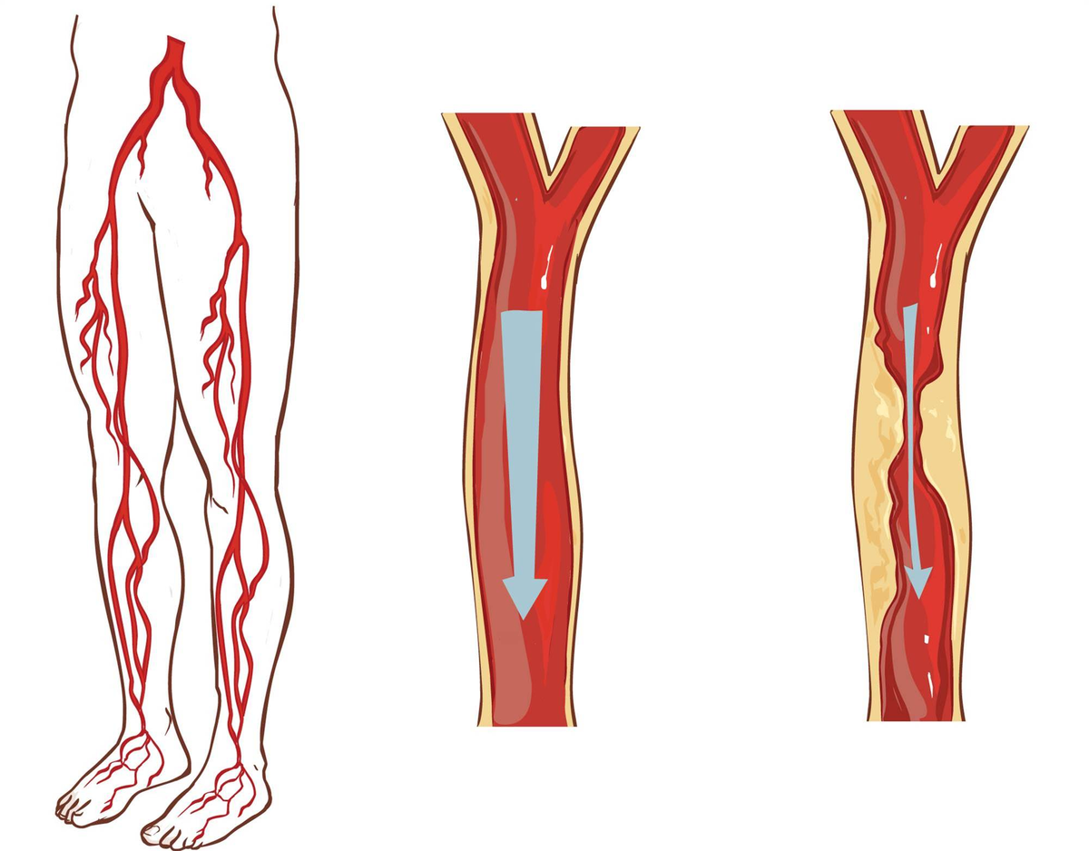 Атеросклероз анатомия. Облитерирующий атеросклероз вен нижних конечностей. Облитерирующий атеросклероз артерий нижних конечностей. Облитерирующий атеросклероз сосудов конечностей. Атеросклероз сосудов нижних конечностей.