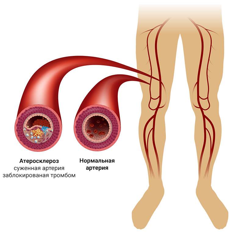 Как вылечить атеросклероз сосудов ног?