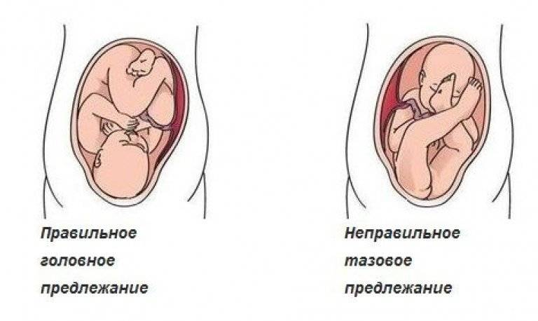 Поперечное положение плода — вопрос №1220843