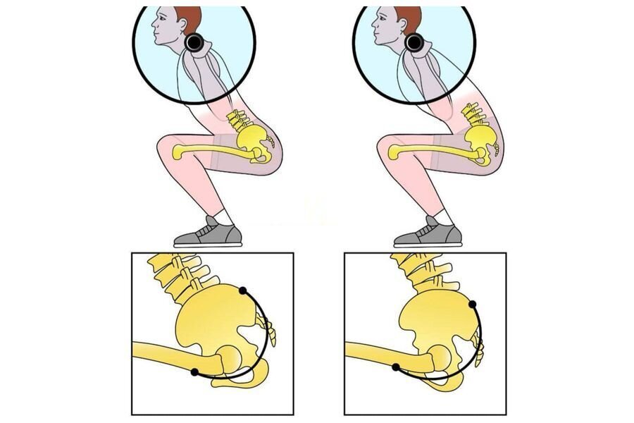 Клевок таза, ссутуливание поясницы в нижней позиции, подкрутка таза и другие названия