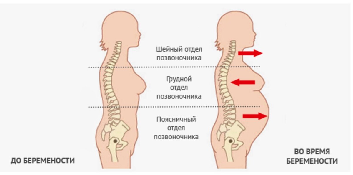 Болит поясница 9 неделя. Изменения позвоночника. Изменения позвоночника у беременных. Осанка беременных. Изменение позвоночника при беременности.