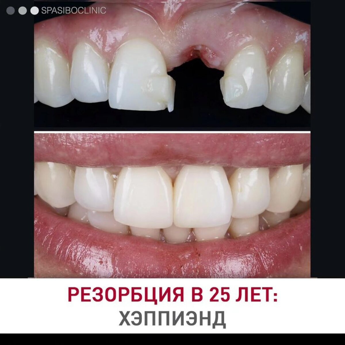 Резорбция шейки переднего зуба у 25-летней девушки: финал лечения.

24 приема в течение 8 месяцев.
Шаг за шагом - чтобы не потерять, а сохранить.