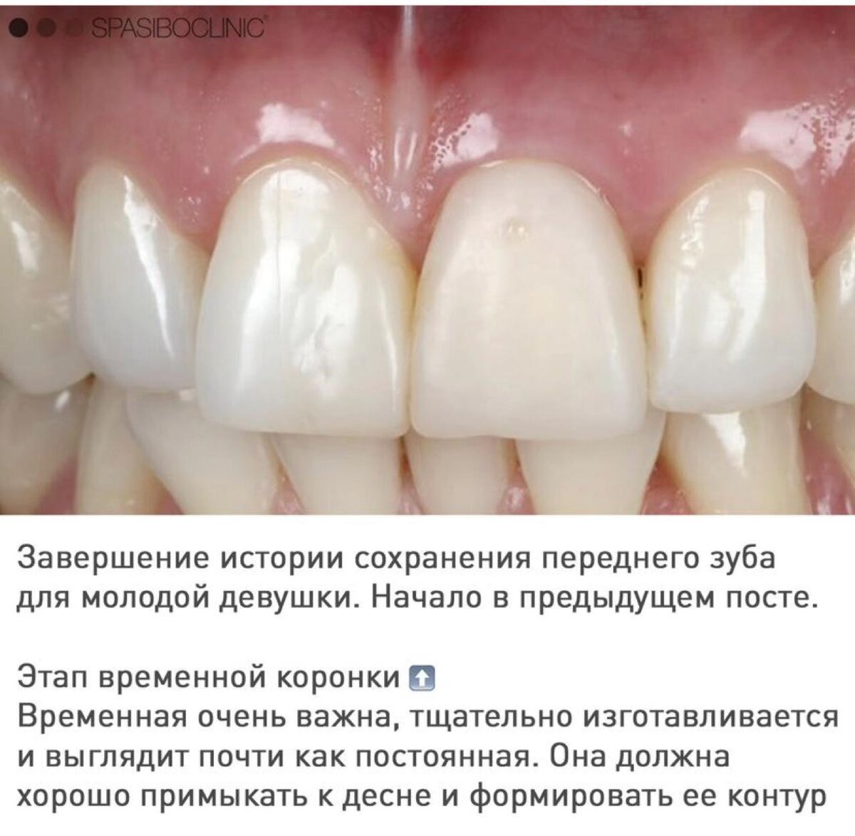 Резорбция шейки переднего зуба у 25-летней девушки: финал лечения.

24 приема в течение 8 месяцев.
Шаг за шагом - чтобы не потерять, а сохранить.-2